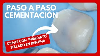 CEMENTACIÓN DE ONLAY DE RESINA COMPUESTA CON SELLADO INMEDIATO EN DENTINA [upl. by Miche]