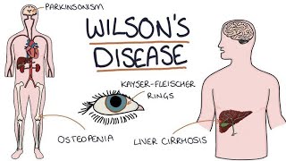 WILSON DISEASE GENETIC DISORDER OF LIVERBSC NURSINGdailypost [upl. by Jerrine]