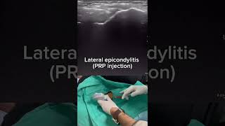 Lateral epicondylitis injection [upl. by Lowell175]