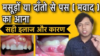 मसूड़ों से पस या मवाद आने का इलाज  मसूड़े मे फुंसी आना मसुडे में पस आने का कारण [upl. by Biegel375]