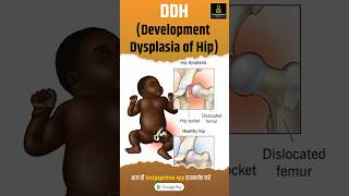 DDH Development Dysplasia of Hip  Pediatric Nursing DDH clubfoot DevelopmentDysplasiahip [upl. by Kevon]