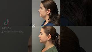 Chin lipo with Renuvion for skin tightening by Dr Z at 3 months postop [upl. by Leinadnhoj]