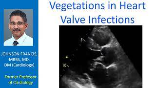 Vegetations in heart valve infections [upl. by Macdougall27]