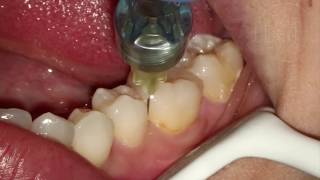 Endodontia de Molar Inferior [upl. by Adni]