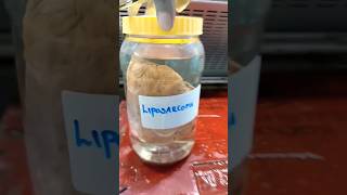 Grossing of liposarcoma specimen  histopathology Lipoma liposarcoma [upl. by Ateloiv]