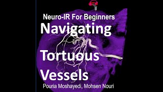 How to Navigate Tortuous Vessels in NeuroEndovascular Procedures [upl. by Aiak]