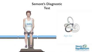 Semont Maneuver A Step by Step Guide to Treat BPPV Vertigo [upl. by Kalil]