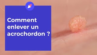 Acrochordons  comment sen débarrasser [upl. by Marlea800]