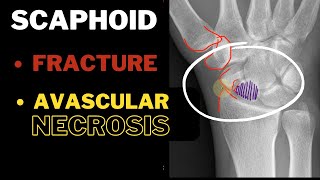 Anatomical Snuff box Part 2 Scaphoid  Fracture AVN  In 3 MINUTES [upl. by Eilyah]