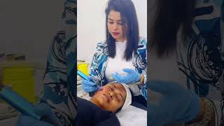 Subicion with microneedling for acne scar කුරුලෑ වලවල් සදහා ප්‍රතිකාර😍doctor foryou fypyoutube [upl. by Anema]