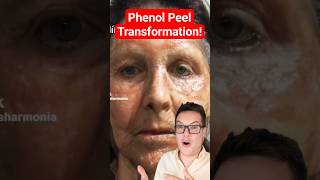 CRAZY PHENOL PEEL BEFORE AND AFTER  Major Results shorts [upl. by Aynnek]