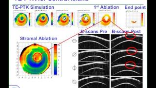 LoVC Course on Therapeutic Corneal Refractive Surgery Part 6 of 6 Protocol for TEPTK [upl. by Kayle]