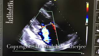 Restrictive Cardiomyopathy [upl. by Liborio]