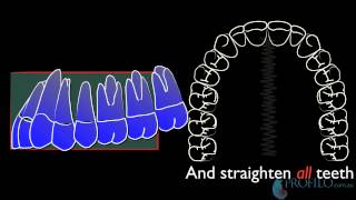 The Crowded Maxilla jaw distraction orthognathic jaw surgery orthodontics braces before amp aftermov [upl. by Zebe]