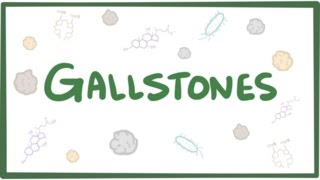 Gallstones cholelithiasis [upl. by Farrish776]