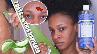 I USED FRESH ALOE VERA amp PURE CASTILE SOAP ON MY FACE FOR 7 DAYS amp THIS HAPPENED [upl. by Eemla]