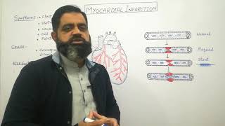 Myocardial infarction Urdu Hindi medium profmasoodfuzail Heart attack  Angioplasty [upl. by Napoleon]