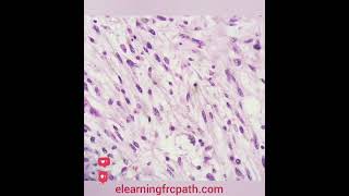 softtissue spindlecell liposarcoma dedifferentiated frcpathpart2 elearningfrcpathcom [upl. by Phail]