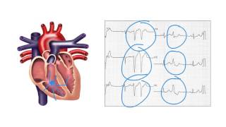 Determining the origin of ventricular ectopic beats on the ECG  Ask Andrew [upl. by Noeled]