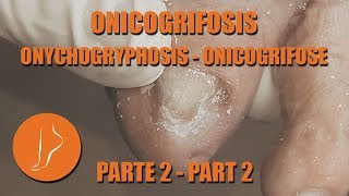 Onicogrifosis 2da parte podologiaintegral [upl. by Annoynek]