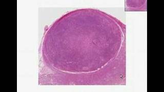 Histopathology Uterus Leiomyoma [upl. by Osrit539]