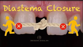 Diastema closure using direct bonding  front wing technique [upl. by Huba]