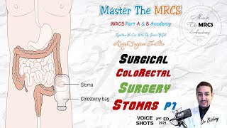 MTM ColoRectal Stomas Illustrated P1 Voice Shots Dr Bishoy 9 2021 [upl. by Glick]