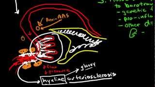 Pathophysiology of Hypertensive Nephropathy [upl. by Ventura]