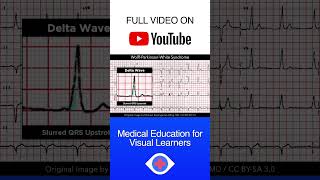 WolffParkinsonWhite Syndrome ECG shorts [upl. by Brawley555]