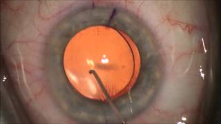 Correction of Astigmatism with Toric Intraocular Lens during cataract surgery See Better [upl. by Releehw778]