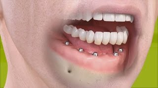 Straumann  Fixed restoration with 46 implants all straight [upl. by Lertram]