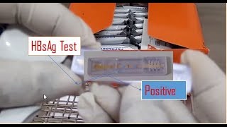 HBsAG Test Positive Hepatitis B test result within 20 minutes Hepatitis B test procedure [upl. by Hapte]