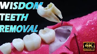 wisdom Tooth Removal  wisdom Tooth Aftercare [upl. by Aisad763]