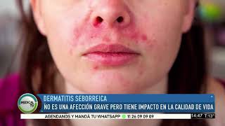 MEDICAL TV Dermatitis Seborreica [upl. by Akeimahs136]