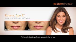 BELOTERO BALANCE  Dermal Filler [upl. by Lizzie]