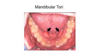 Preprosthetic surgery Hard tissue procedures [upl. by Gerald721]