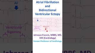 Atrial Fibrillation and Bidirectional Ventricular Ectopy [upl. by Ali]