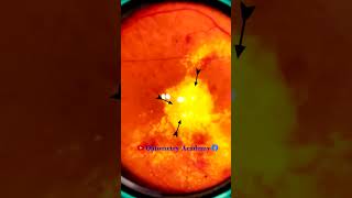 Diabetic retinopathy  Hemorrhages  Hard exudates  Fundus  Short Video 191 [upl. by Bank]