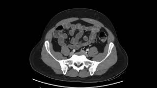 How to read a CT of the Abdomen and Pelvis  a quick practical approach axial [upl. by Assenal]