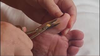 Callus Cutting Saga callus cutting toe callo occhio di pernice [upl. by Ennovahc]