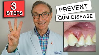 3 Easy Ways to Prevent Gum Disease at Home [upl. by Norrv815]