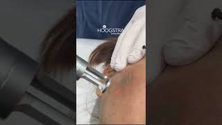 Eliminación de tatuaje con láser  R24097 [upl. by Viridis]