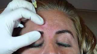 Glabellar Botox Injection Technique  Botox Class [upl. by Affra241]