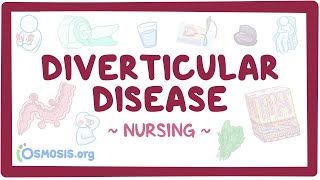 Diverticular disease Clinical Nursing Care [upl. by Adnorahc]