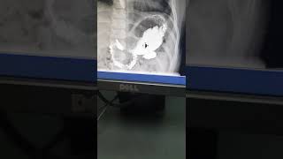 Serie Esófago Gastro Duodenal SEGD en Niños [upl. by Bertha410]