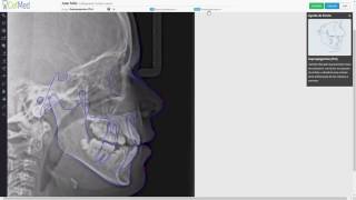 CefMed cefalometría  Cómo crear cefalogramas [upl. by Fahland620]