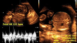 About 23 weeks 3 days pregnancy  Practical case  Ultrasonography finding [upl. by Caine]