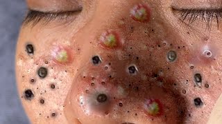 Big Cystic Acne Blackheads Extraction Blackheads amp Milia Whiteheads Removal Pimple Popping  6561 [upl. by Scheck]