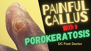 Painful Callus with a Porokeratosis [upl. by Yelik949]