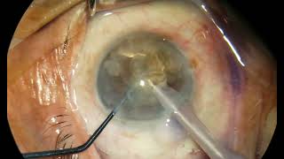 No iris hooks synechiae hardcataract brunescentcataract [upl. by Ecirehs182]